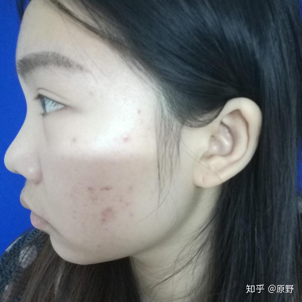 激光祛痘，重塑肌膚的完美選擇，激光祛痘，重塑肌膚，追求完美選擇