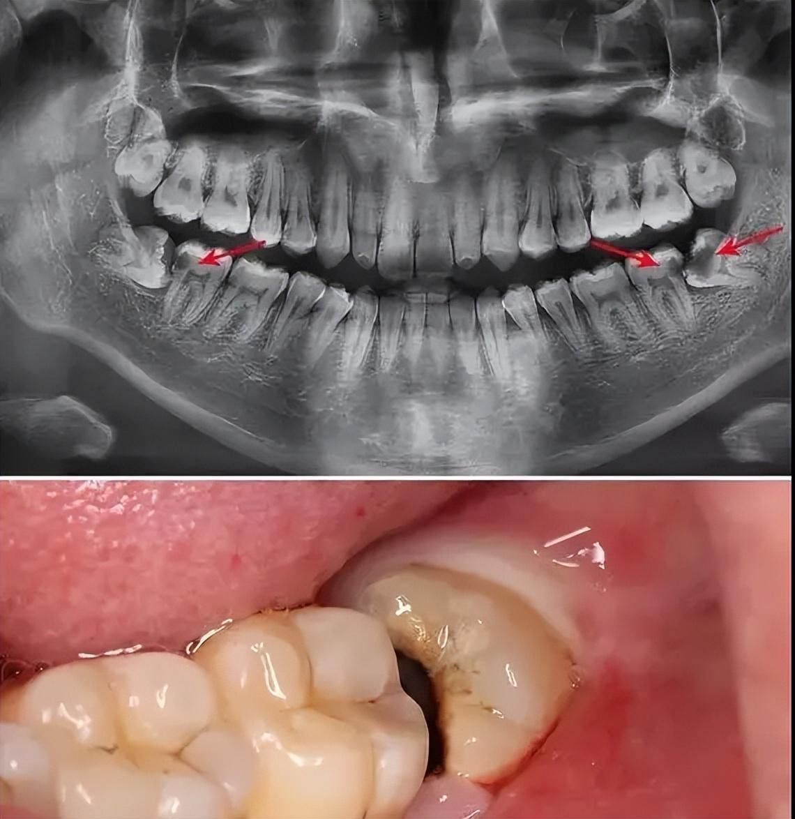 智齒拔除，全面解析智齒拔除前后的注意事項(xiàng)，智齒拔除詳解，前后注意事項(xiàng)全面解析