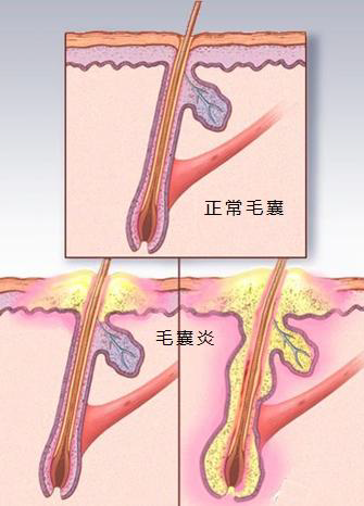 痤瘡和毛囊炎的區(qū)別，深入了解兩種常見皮膚疾病的差異，痤瘡與毛囊炎的區(qū)別，深入剖析兩種皮膚疾病的異同