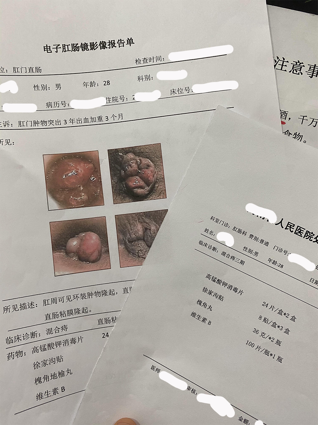 痔瘡肉球，一度、二度、三度的圖片解析與理解，痔瘡肉球，一度、二度、三度癥狀圖片解析及理解指南