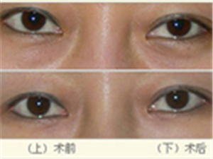 去除眼袋
