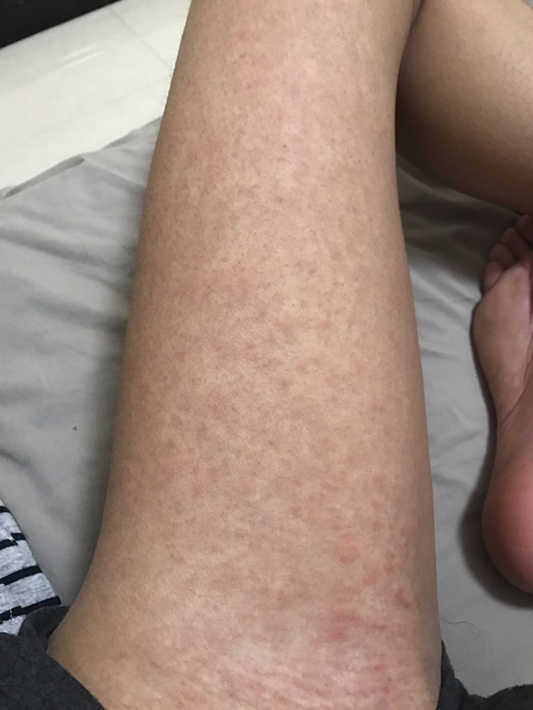 過敏多久會(huì)自行消退，深入了解過敏反應(yīng)及其恢復(fù)時(shí)間，過敏反應(yīng)恢復(fù)時(shí)間與自行消退的探討，深入了解過敏反應(yīng)恢復(fù)過程