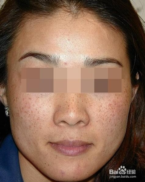 黃褐斑能否自行消退？深度解析黃褐斑成因與應(yīng)對(duì)方法，黃褐斑成因深度解析及應(yīng)對(duì)消退方法探討，能否自行消退？