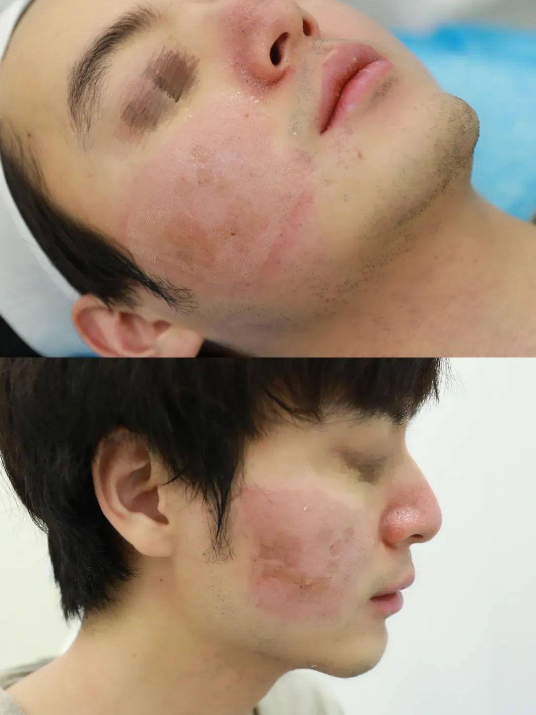 點陣激光去疤痕3次對比，效果與體驗分享，點陣激光三次祛疤對比，效果與親身體驗分享