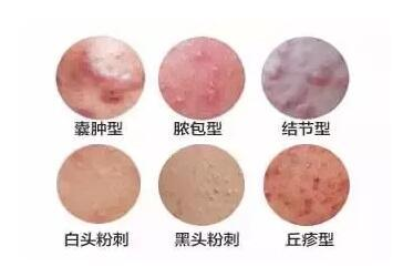青春痘會(huì)自己消失嗎？——解析青春痘及其自然消退的可能性，青春痘的自然消退可能性解析，是否會(huì)自行消失？