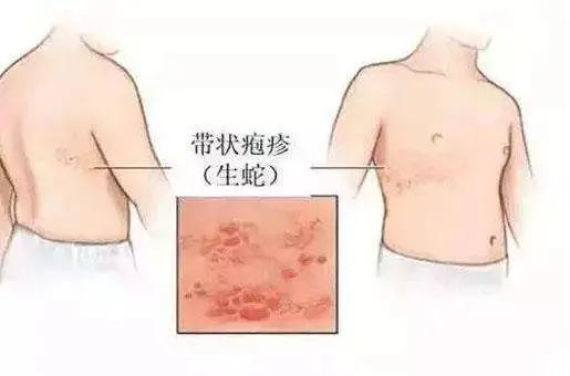 皰疹是什么原因長的？全面解析皰疹成因，皰疹成因全面解析，皰疹是如何產(chǎn)生的？