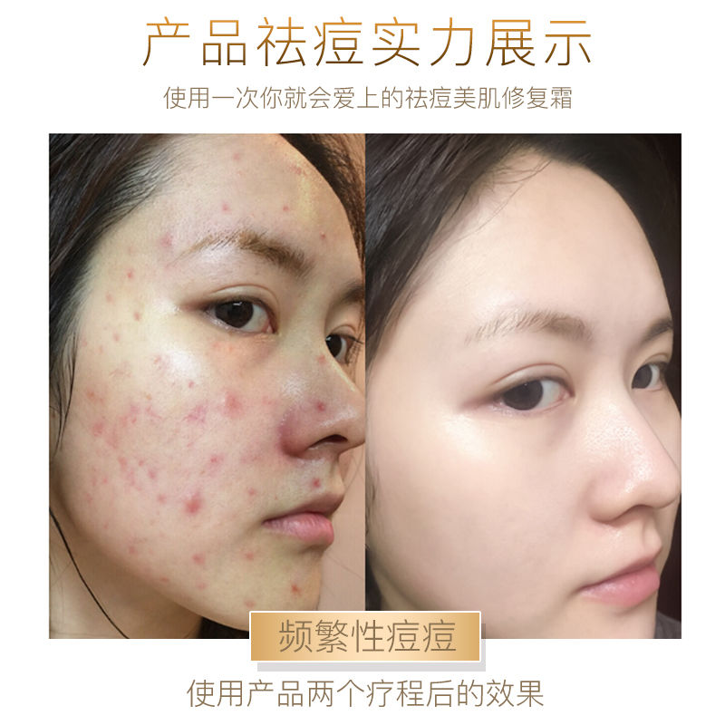 臉上痘印痘坑痘疤修復(fù)全攻略，專業(yè)方法與日常護(hù)理建議，專業(yè)修復(fù)痘印痘坑痘疤全攻略，專業(yè)方法與日常護(hù)理建議