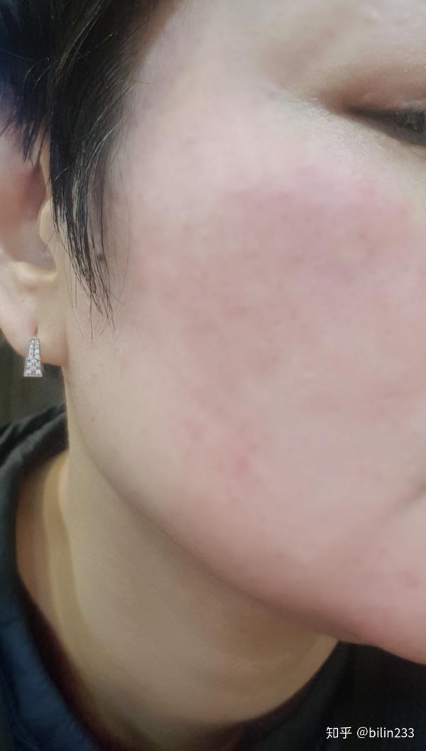 如何判斷自己是否過敏了？識別過敏癥狀與應對方法，如何識別過敏癥狀及應對方法？判斷自身過敏跡象全解析。