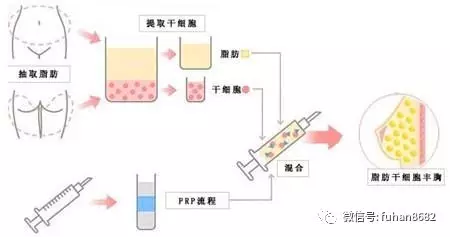 豐胸針一針管幾年與價格解析，豐胸針效果持續(xù)時間與價格解析