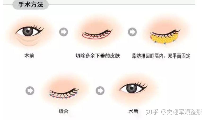 眼袋手術(shù)費(fèi)用詳解，價(jià)格、因素與選擇，眼袋手術(shù)費(fèi)用全解析，價(jià)格、影響因素與選擇策略