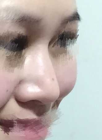 捏了三年鼻梁的對(duì)比，變化與影響深度解析，捏鼻三年，深度解析鼻梁變化與影響