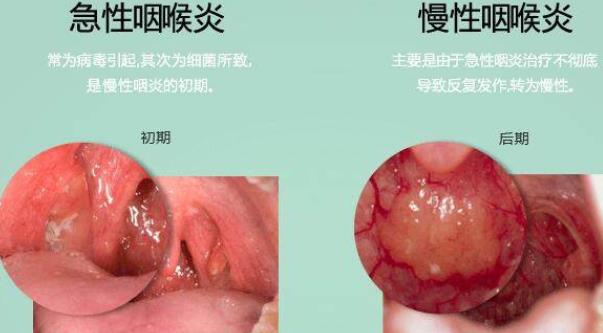 咽喉炎癥狀及表現(xiàn)詳解，咽喉炎癥狀及表現(xiàn)的全面解析