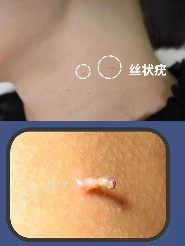 關(guān)于HPV感染，個(gè)人經(jīng)歷與感受分享，HPV感染，我的個(gè)人經(jīng)歷與感悟分享