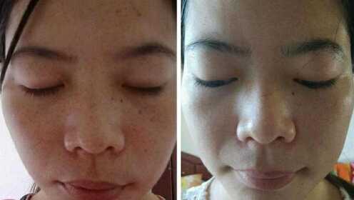 如何消除臉上斑點(diǎn)，全面解析祛斑方法，全面解析，消除臉上斑點(diǎn)的方法與技巧