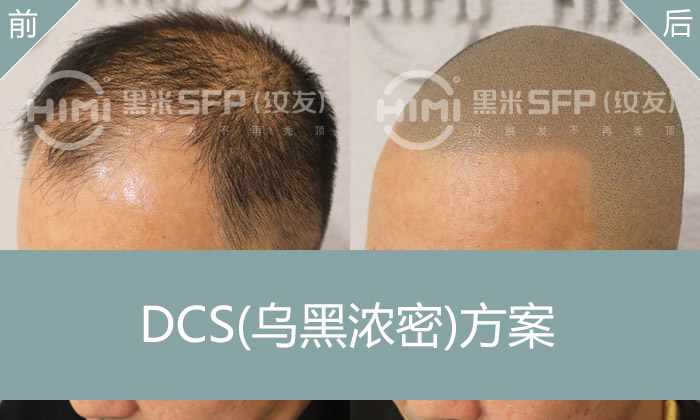 探索治療脫發(fā)的26種土方法，自然療法的秘密與實用技巧，揭秘自然療法，26種土方法探索脫發(fā)治療之道