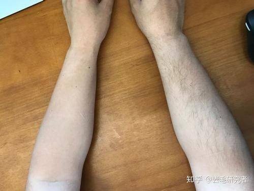 脫毛膏能否永久脫毛？深度解析脫毛膏的效用與注意事項，深度解析，脫毛膏的效用、永久性與使用注意事項
