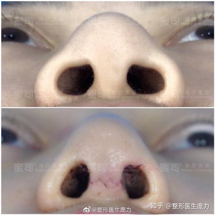 鼻頭大怎么才能縮小——專業(yè)指南與實(shí)用建議，鼻頭大如何縮小，專業(yè)指南及實(shí)用建議