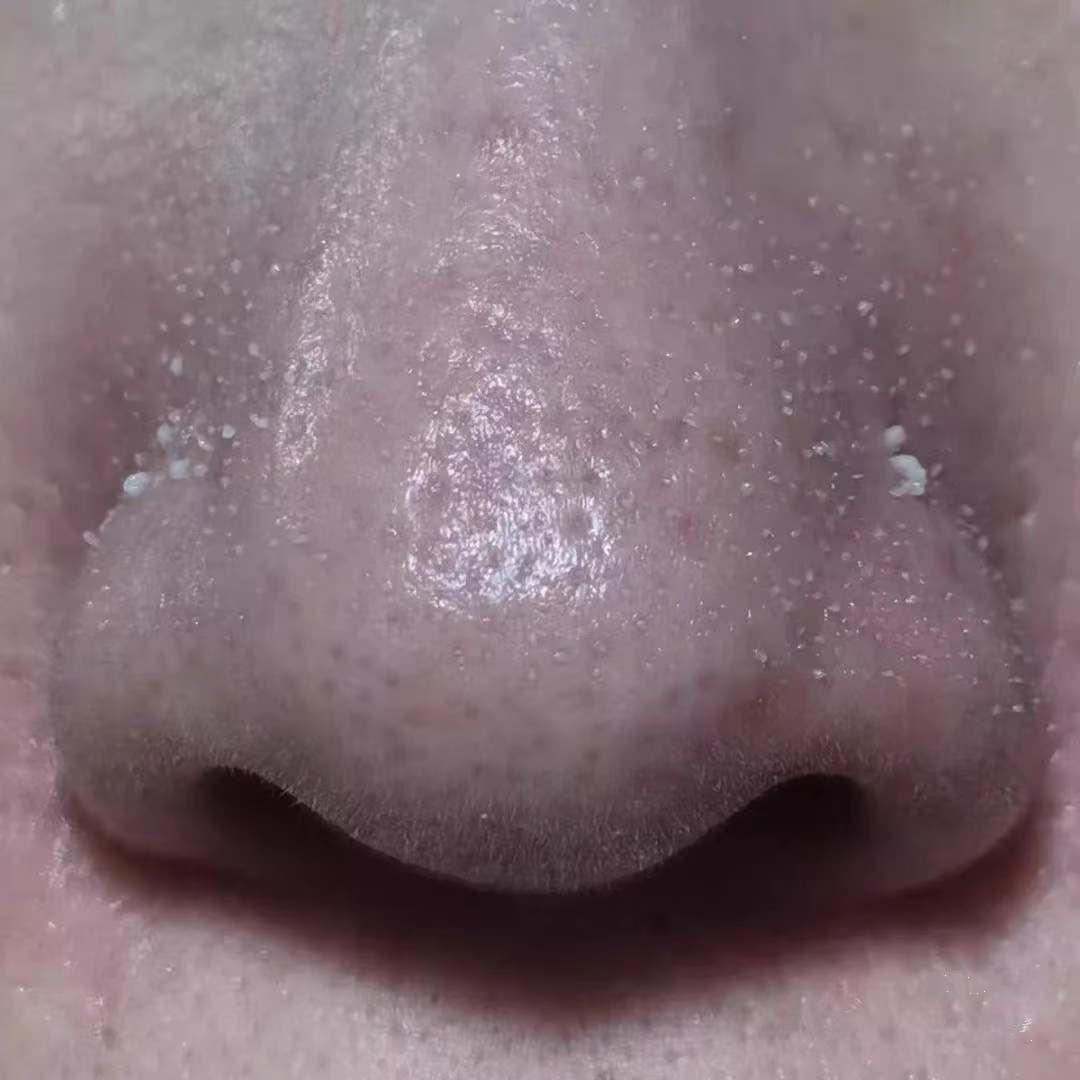 如何正確清理鼻子上的黑頭——全面指南，全面指南，如何正確清理鼻子上的黑頭