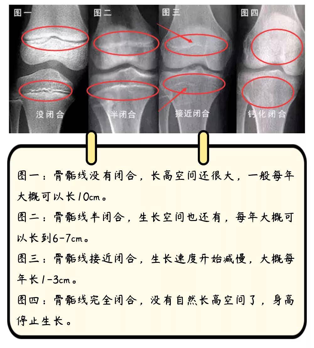 關(guān)于骨骼閉合的年齡，一般多少歲？，骨骼閉合年齡揭秘，一般在多少歲？