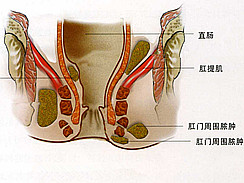 肛周膿腫，了解、預(yù)防與治療，肛周膿腫，全面解析、預(yù)防與治療方法