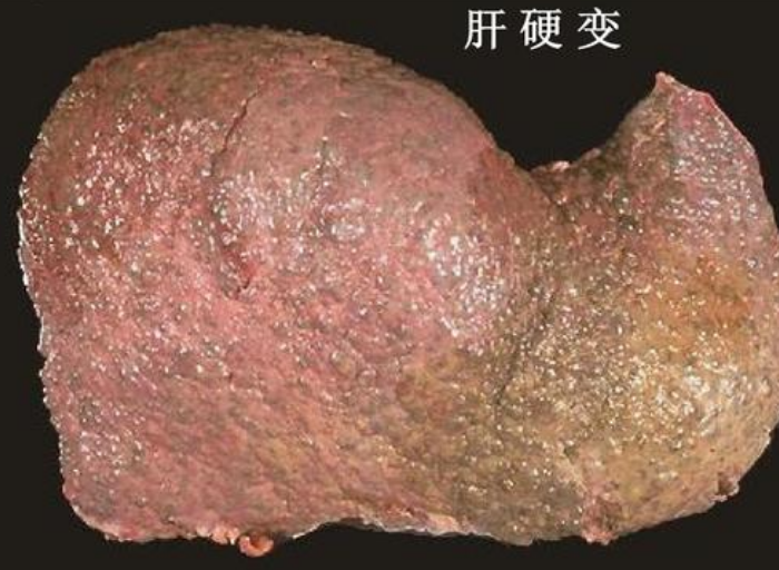 肝開始硬化，生命還能持續(xù)多久？——深入了解肝硬化及其影響因素，肝硬化對生命的影響，深入了解及其影響因素，生命還能持續(xù)多久？