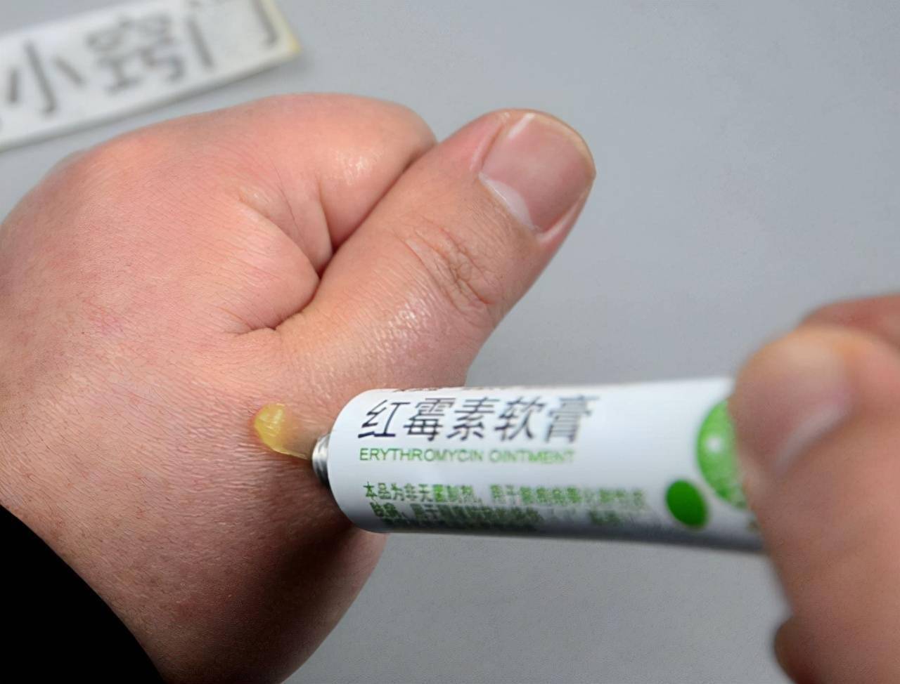 紅霉素軟膏是否可以治療外陰白斑？解析與指導(dǎo)，紅霉素軟膏能否治療外陰白斑？詳解及指導(dǎo)建議