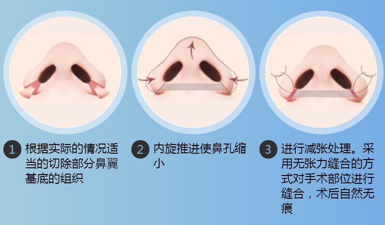 鼻翼縮小手術，重塑自信與美麗，鼻翼縮小手術，重塑自信，綻放美麗光彩