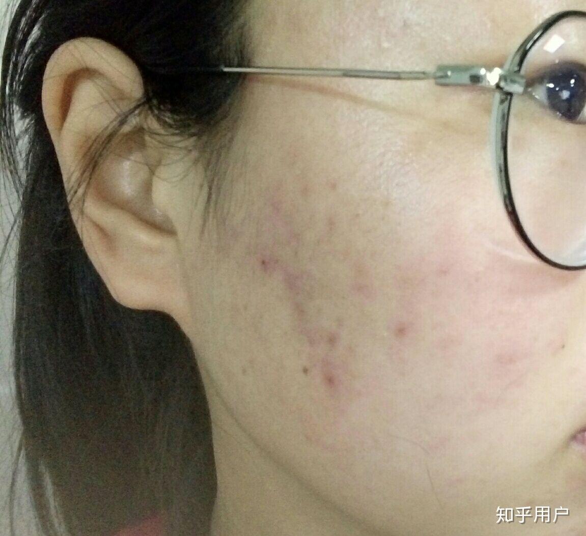 維A酸乳膏，了解真相，避免誤解，維A酸乳膏真相解析，避免使用誤解