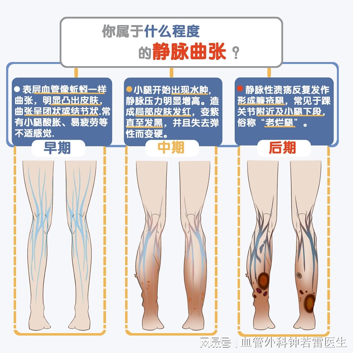 靜脈曲張的最佳治療方法探討，靜脈曲張最佳治療方法探討與研究