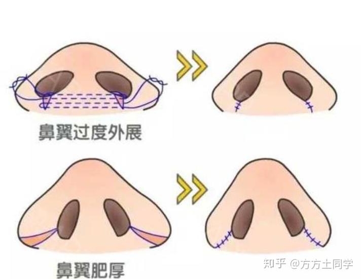 鼻翼縮小手術(shù)價(jià)格表詳解，費(fèi)用構(gòu)成與影響因素分析，鼻翼縮小手術(shù)費(fèi)用詳解，價(jià)格表、構(gòu)成因素與影響因素分析