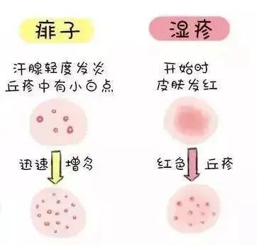 熱疹與濕疹，區(qū)分關(guān)鍵，圖片詳解助您一目了然，熱疹與濕疹詳解，區(qū)分要點(diǎn)及圖片輔助解析