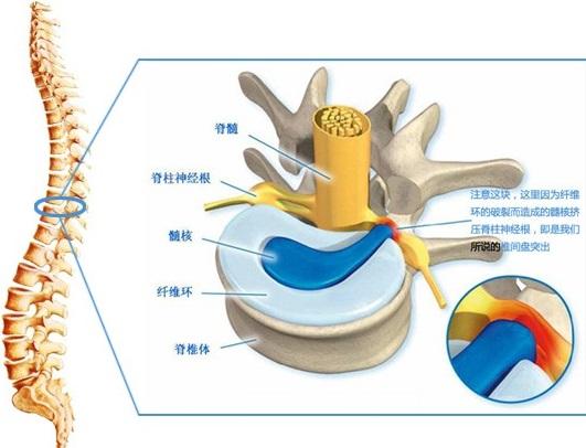 腰椎間盤突出能自愈嗎？解析癥狀與治療方法，腰椎間盤突出解析，自愈可能性、癥狀及治療方法探討