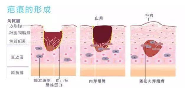 疤痕修復(fù)最佳時間，了解與把握關(guān)鍵時機，疤痕修復(fù)最佳時機解析，把握關(guān)鍵時間，實現(xiàn)無痕恢復(fù)