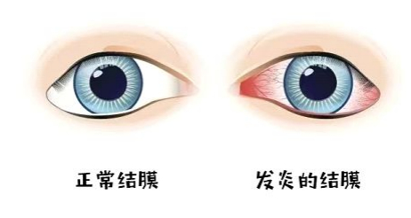 結(jié)膜炎，癥狀、預防與治療的重要性，揭秘結(jié)膜炎，癥狀、預防與治療的重要性全解析