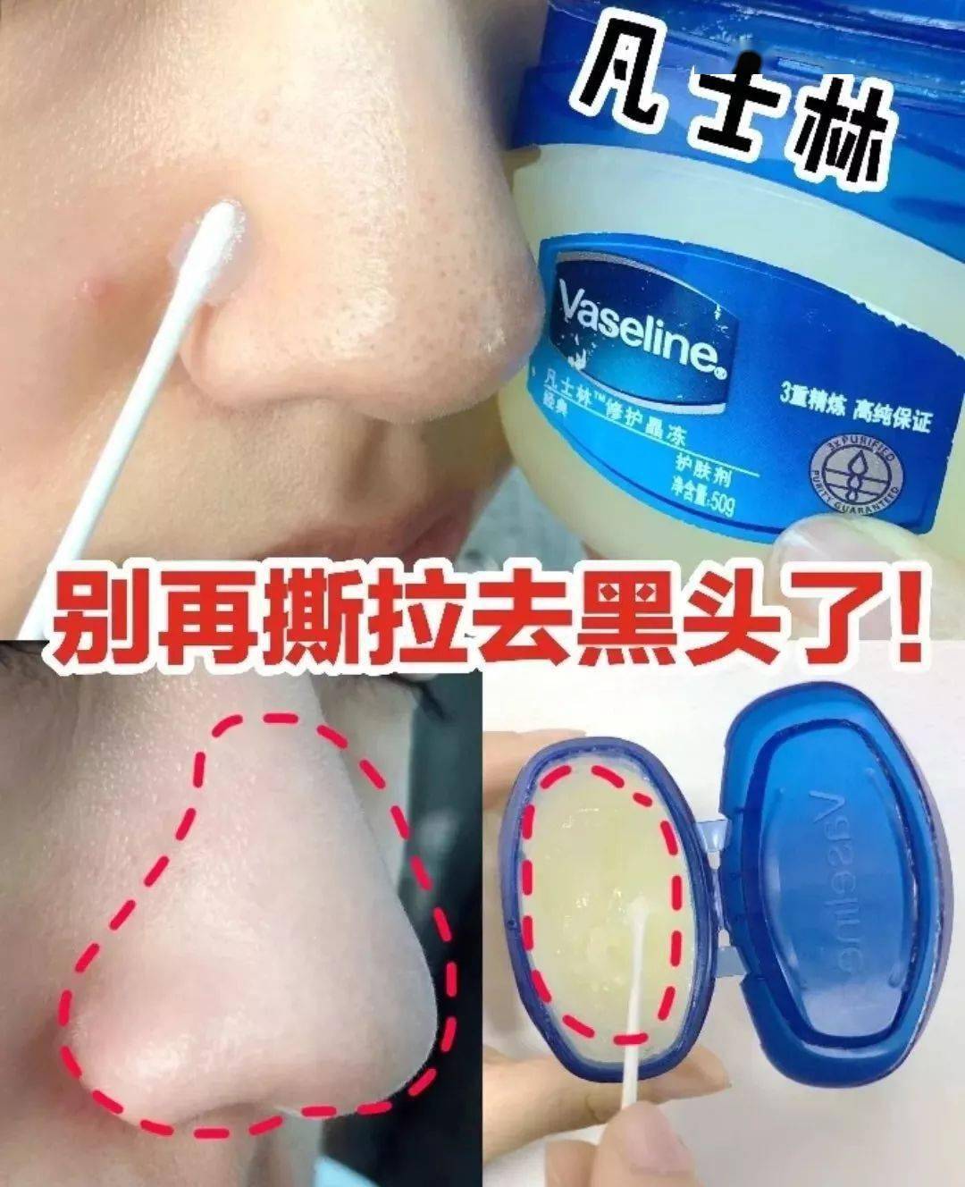 怎么去黑頭——全方位黑頭解決方案，全方位去黑頭指南——解決黑頭的有效方法