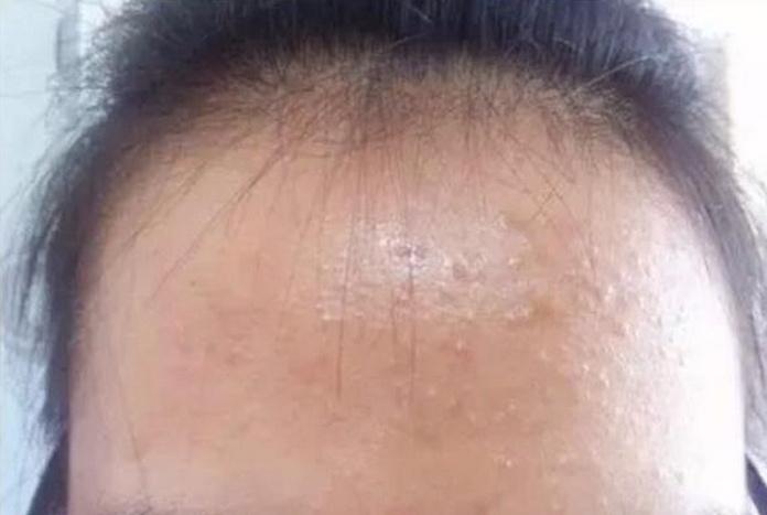 臉上痘痘去除小竅門，全方位指南，臉部痘痘消除全方位指南，實用小竅門總結(jié)