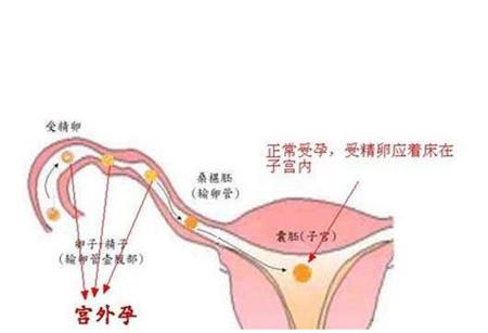 宮外懷孕的前兆，了解并預(yù)防早期征兆，宮外懷孕早期征兆解析與預(yù)防策略