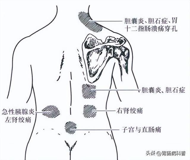 闌尾炎的三大壓痛點圖片詳解，闌尾炎三大壓痛點詳解圖解