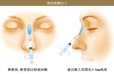 注射隆鼻不滿意？了解如何安全取出注射物，如何安全取出注射物，解決注射隆鼻不滿意問題的方法