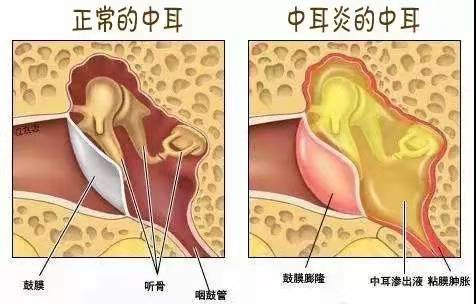 如何判斷自己是否得了中耳炎？全面解析中耳炎癥狀及診斷方法，中耳炎癥狀解析，如何判斷與診斷中耳炎？