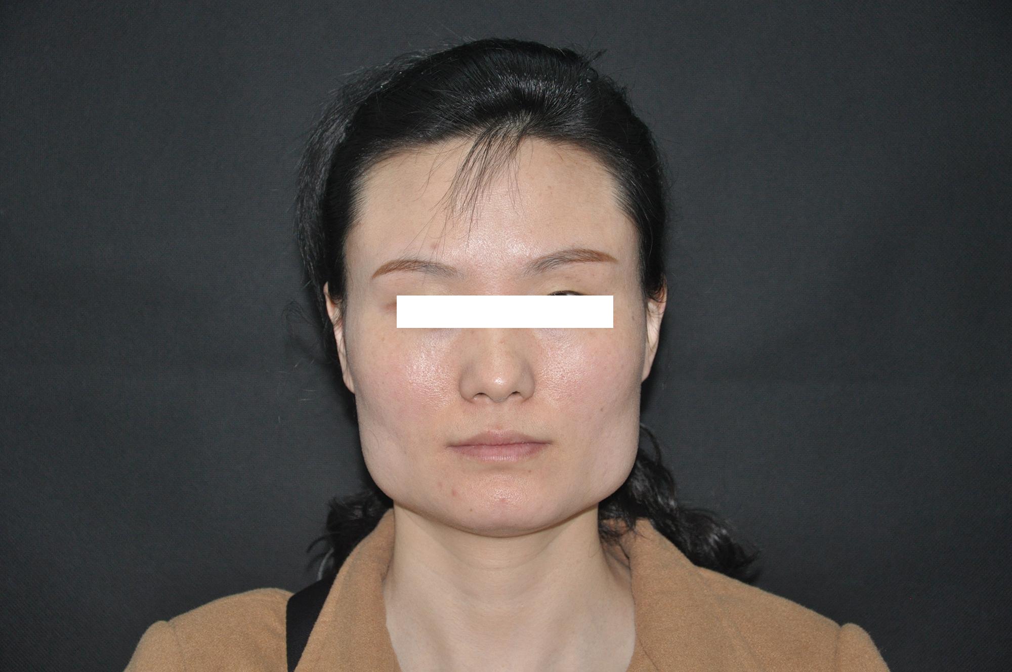 瘦臉針需要一直打下去嗎？深入了解與科學(xué)解答，關(guān)于瘦臉針，是否需要持續(xù)注射及深入了解與科學(xué)解答