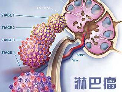淋巴瘤早期癥狀及其識別，淋巴瘤早期癥狀識別與解析