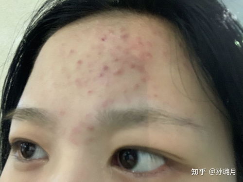 怎么去青春痘——全方位指南，全方位指南，青春痘消除方法與策略