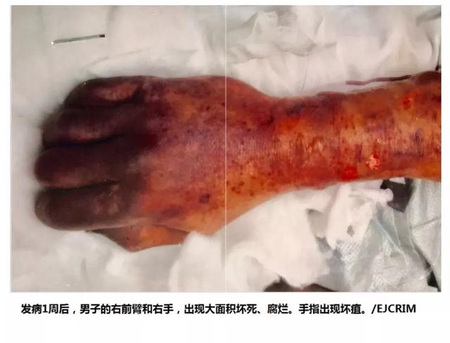 男人感染了真菌圖片，了解、預(yù)防與治療，男人真菌感染，圖片解析、預(yù)防與治療方法