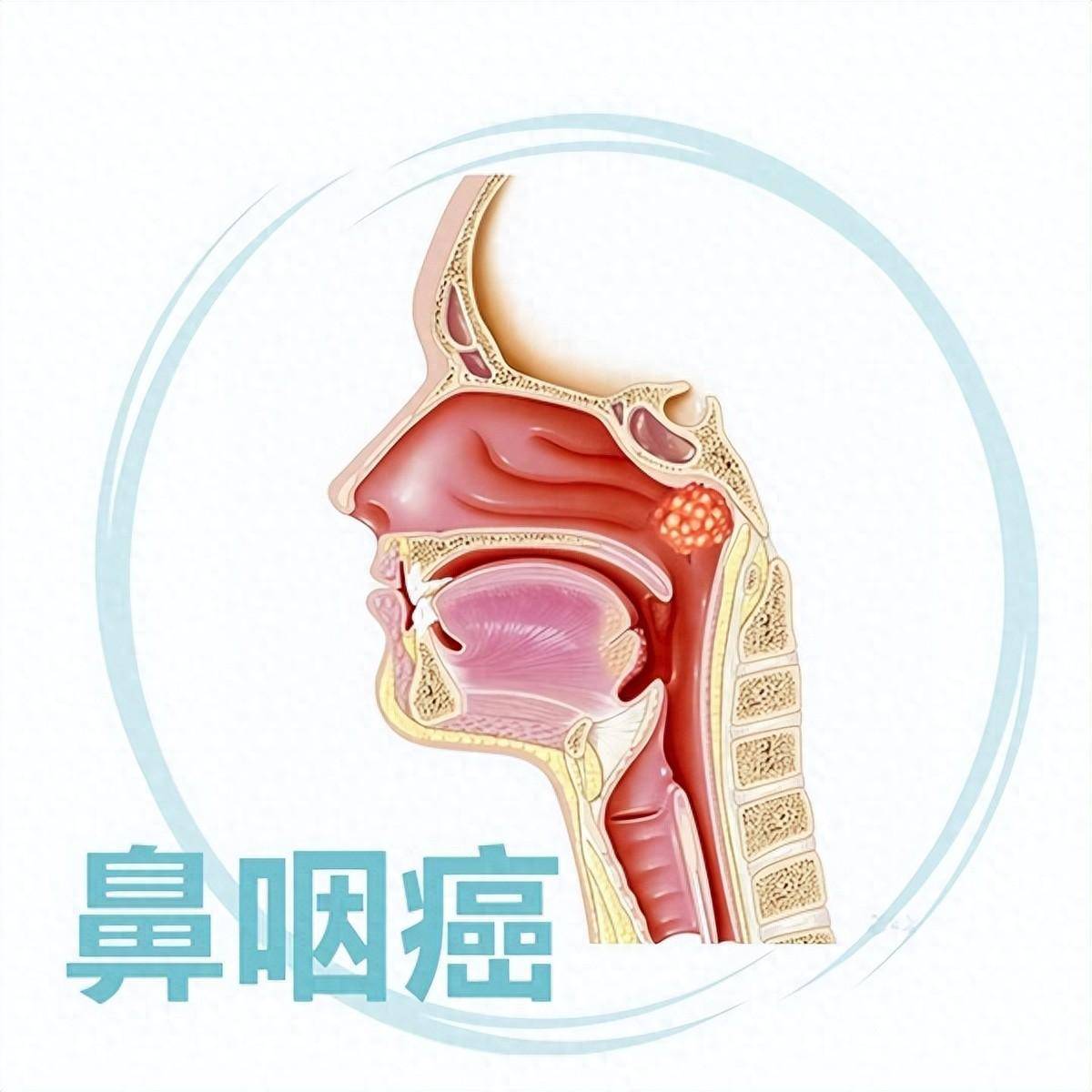 鼻咽癌早期的五大癥狀及其識別重要性，鼻咽癌早期五大癥狀及識別重要性指南