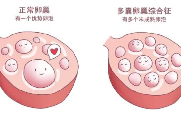 小姑娘為什么會得多囊卵巢？解讀卵巢健康與預防策略，小姑娘得多囊卵巢的原因及卵巢健康與預防策略解讀