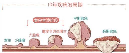 腸癌早期癥狀及其識別重要性，腸癌早期癥狀及識別的重要性