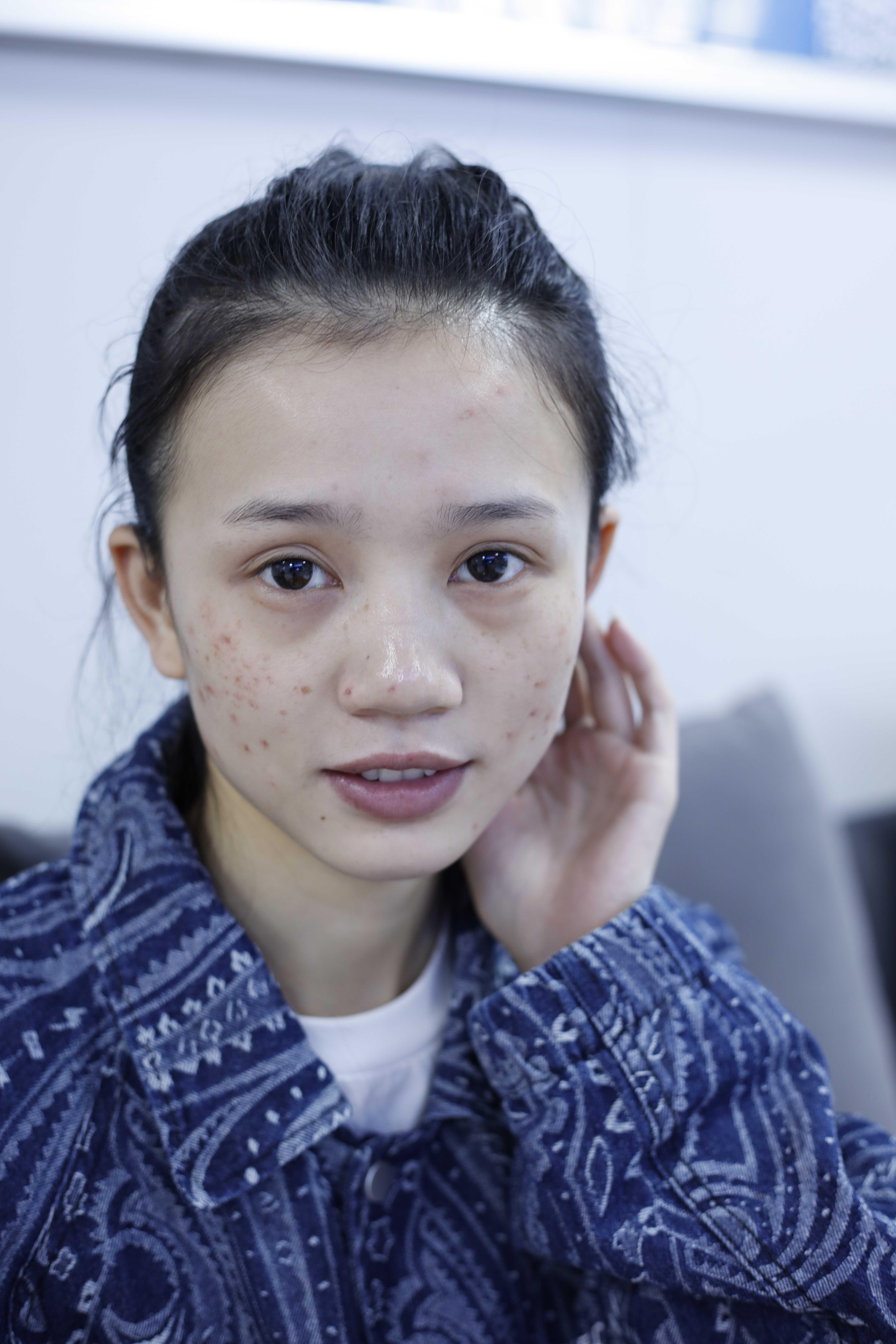 激光痘印治療，次數(shù)與效果解析，激光痘印治療，次數(shù)與效果的深度解析