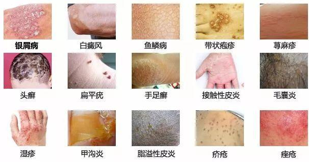 十八種常見皮膚病圖片詳解，十八種常見皮膚病詳解及圖片介紹