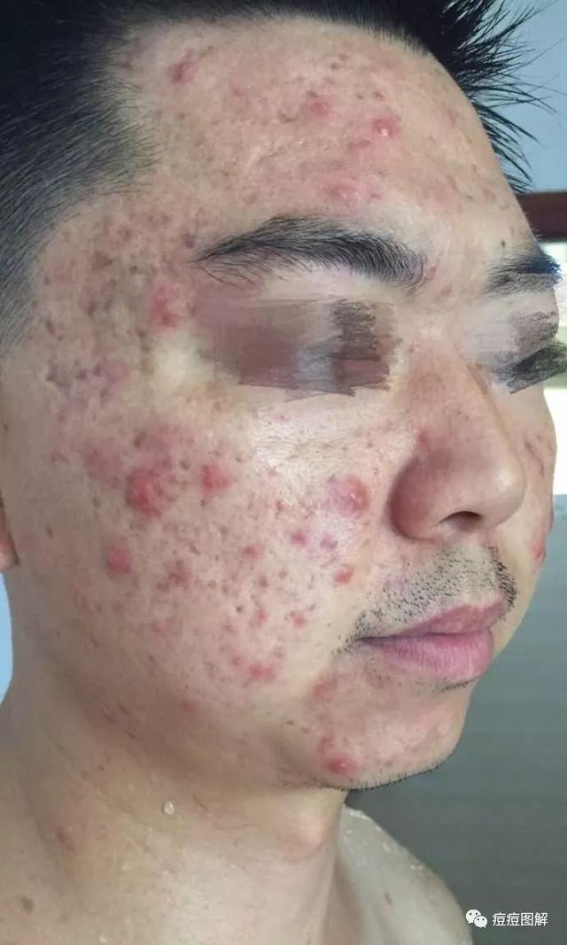 面部痤瘡怎么治療最徹底，全方位解析最佳解決方案，全方位解析，如何徹底治療面部痤瘡，最佳解決方案分享